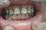 לאחר ציפוי חרסינה לשיניים