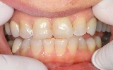 לפני ציפוי חרסינה לשיניים