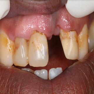 טיפול שיניים בעפולה - סיפור מקרה