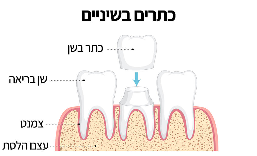 כתר בשיניים