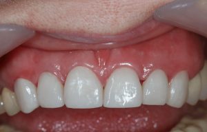 ציפוי חרסינה לשיניים - אחרי