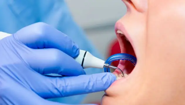 הסרת אבנית מהשיניים במרפאת שיניים