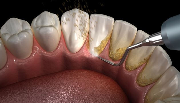 אבנית בשיניים